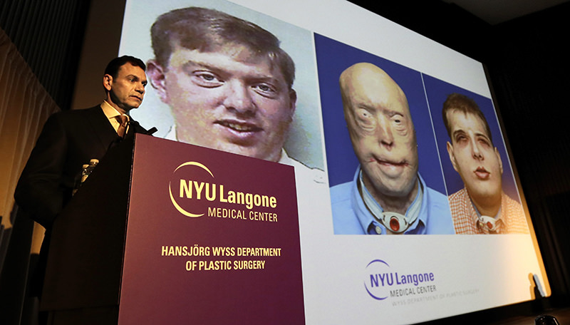 Dr. Eduardo Rodriguez (L) who performed the facial transplant on recipient Patrick Hardison, speaks at a press conference (EPA Photo)