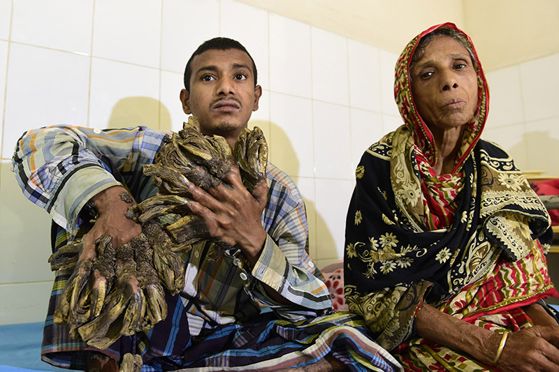 Abul Bajandar (L), 26, dubbed ,Tree Man,, sits at Dhaka Medical College Hospital in Dhaka on January 31, 2016. (AFP Photo)