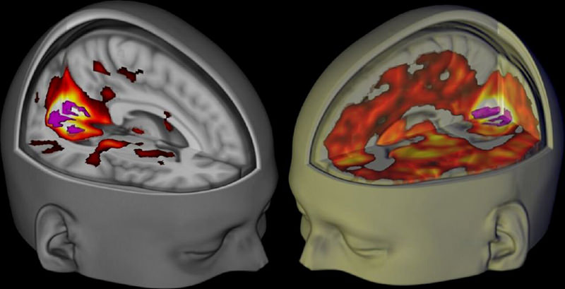 The brains of subjects lying awake with their eyes closed, under a placebo (L) and the drug LSD (R). (REUTERS Photo)