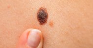 Remember the ABCDE rule when checking for unusual moles and growths on the skin. (iStock Photo)