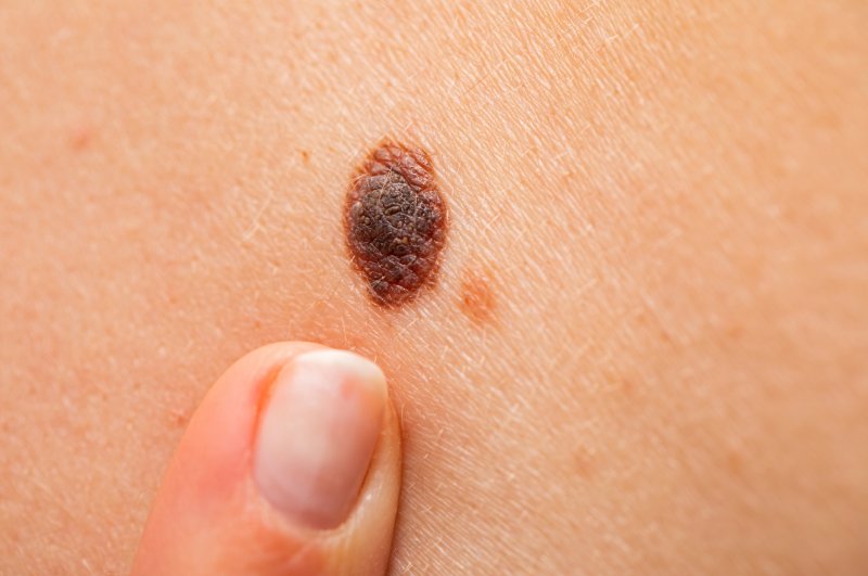 Remember the ABCDE rule when checking for unusual moles and growths on the skin. (iStock Photo)
