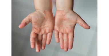 Some people with Behçet's disease develop acnelike spots on their bodies. (iStock Photo)