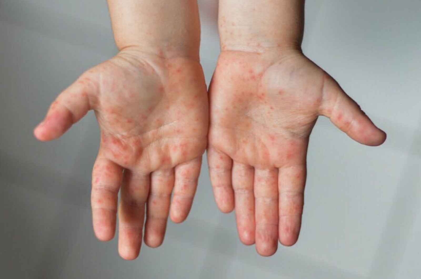 Some people with Behçet's disease develop acnelike spots on their bodies. (iStock Photo)