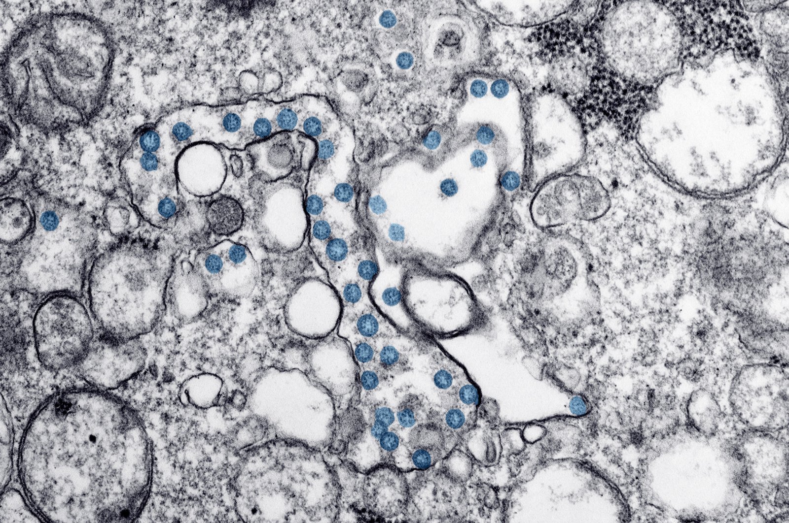 This 2020 electron microscope image made available by the U.S. Centers for Disease Control and Prevention shows the spherical particles of the new coronavirus, colorized blue, from the first U.S. case of COVID-19. (AP Photo)