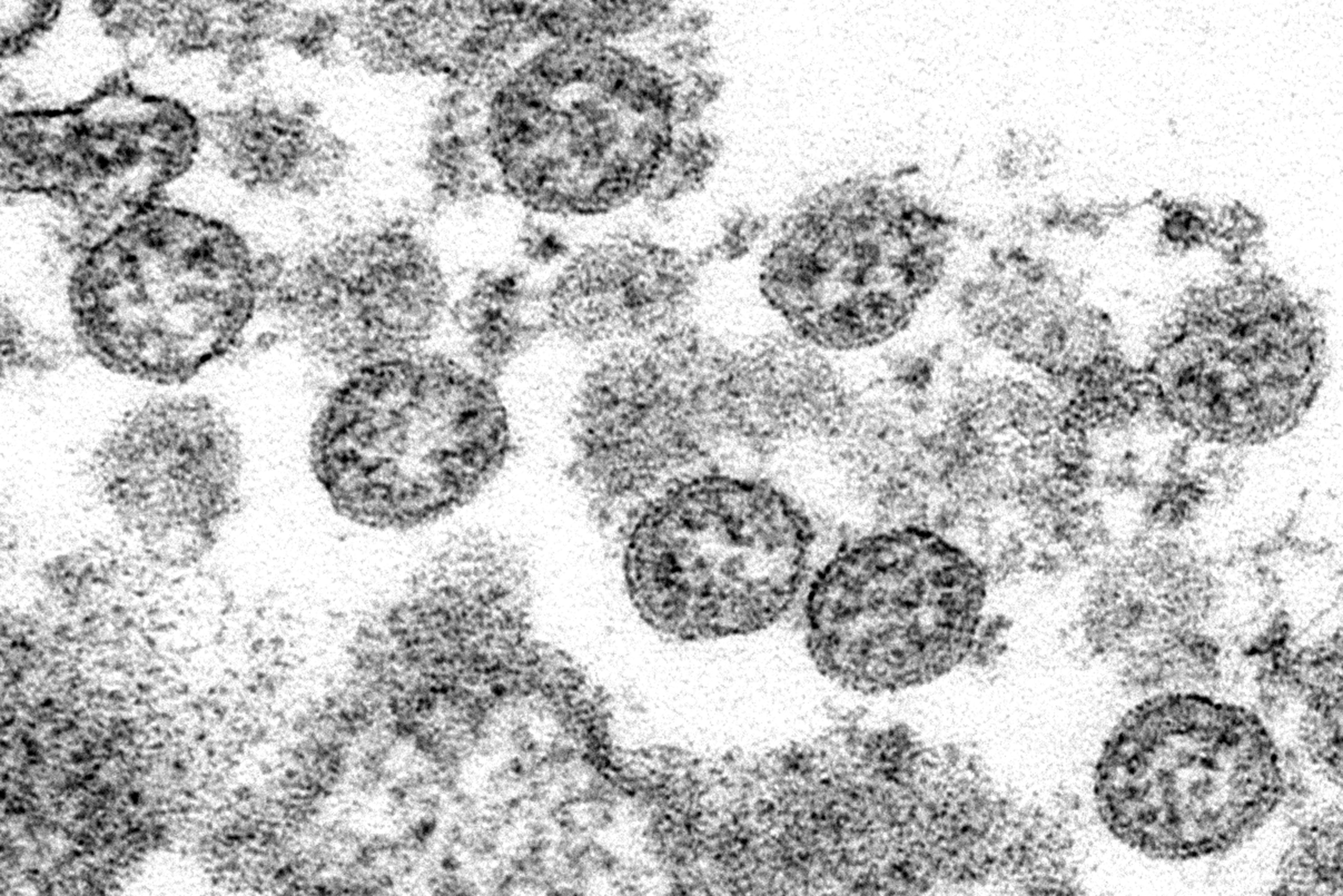 This 2020 electron microscope made available by the U.S. Centers for Disease Control and Prevention image shows the spherical coronavirus particles from the first U.S. case of COVID-19. (C.S. Goldsmith, A. Tamin/CDC via AP)