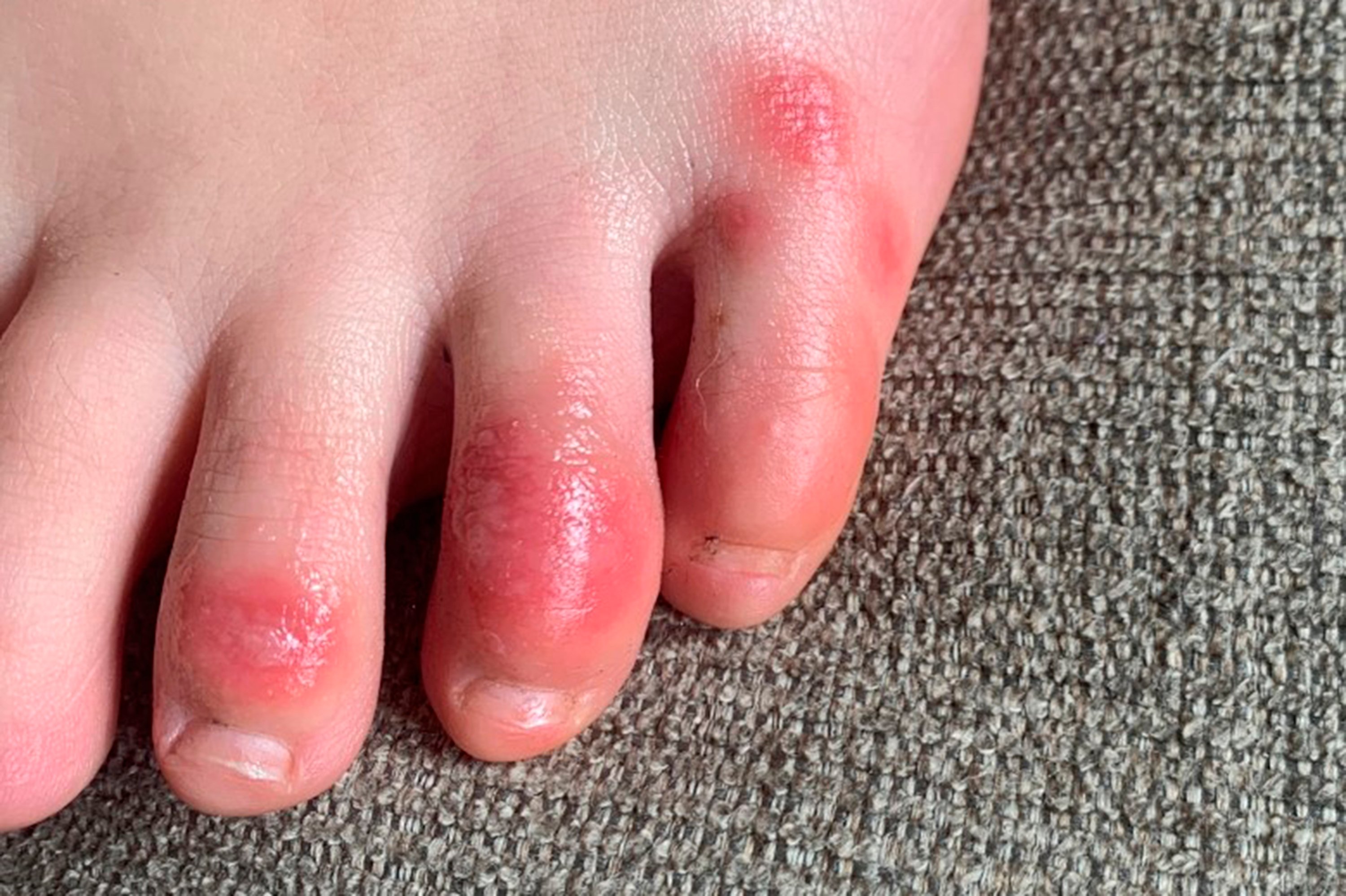  This photo provided by Northwestern University shows discoloration on a teenage patient's toes at the onset of the condition informally called 