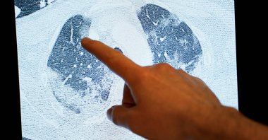 A doctor shows on screen the scan of the lungs of a patient infected by the COVID-19, at the "middle care" unit for COVID-19 patients at Erasme Hospital in Brussels, on April 30, 2020. (AFP Photo)