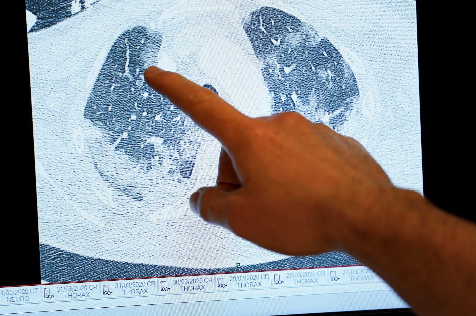 A doctor shows on screen the scan of the lungs of a patient infected by the COVID-19, at the "middle care" unit for COVID-19 patients at Erasme Hospital in Brussels, on April 30, 2020. (AFP Photo)