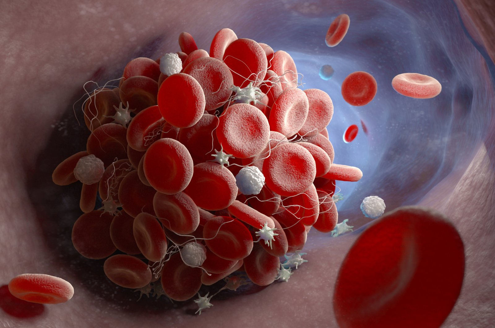 A depiction of a blood clot forming inside a blood vessel. (3D illustration/iStock)