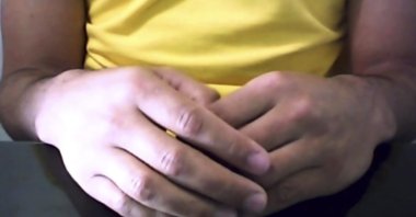 This image made from a video shows the hands of a Brazilian man who was infected with the AIDS virus and has shown no sign of it for more than a year since he stopped HIV medicines after an intense experimental drug therapy aimed at purging the dormant virus from his body, July 7, 2020. (AP Photo)