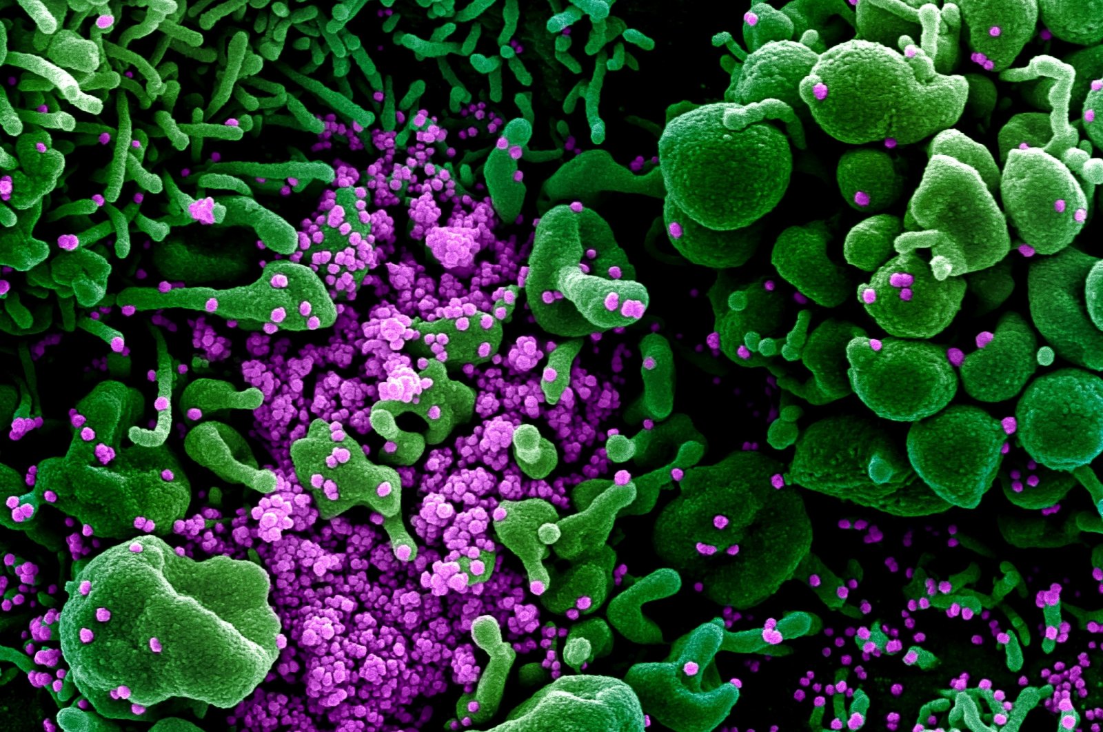 Colorized scanning electron micrograph of an apoptotic cell (green) heavily infected with SARS-COV-2 virus particles (purple), isolated from a patient sample. (NIAID Integrated Research Facility (IRF)/Handout via REUTERS)