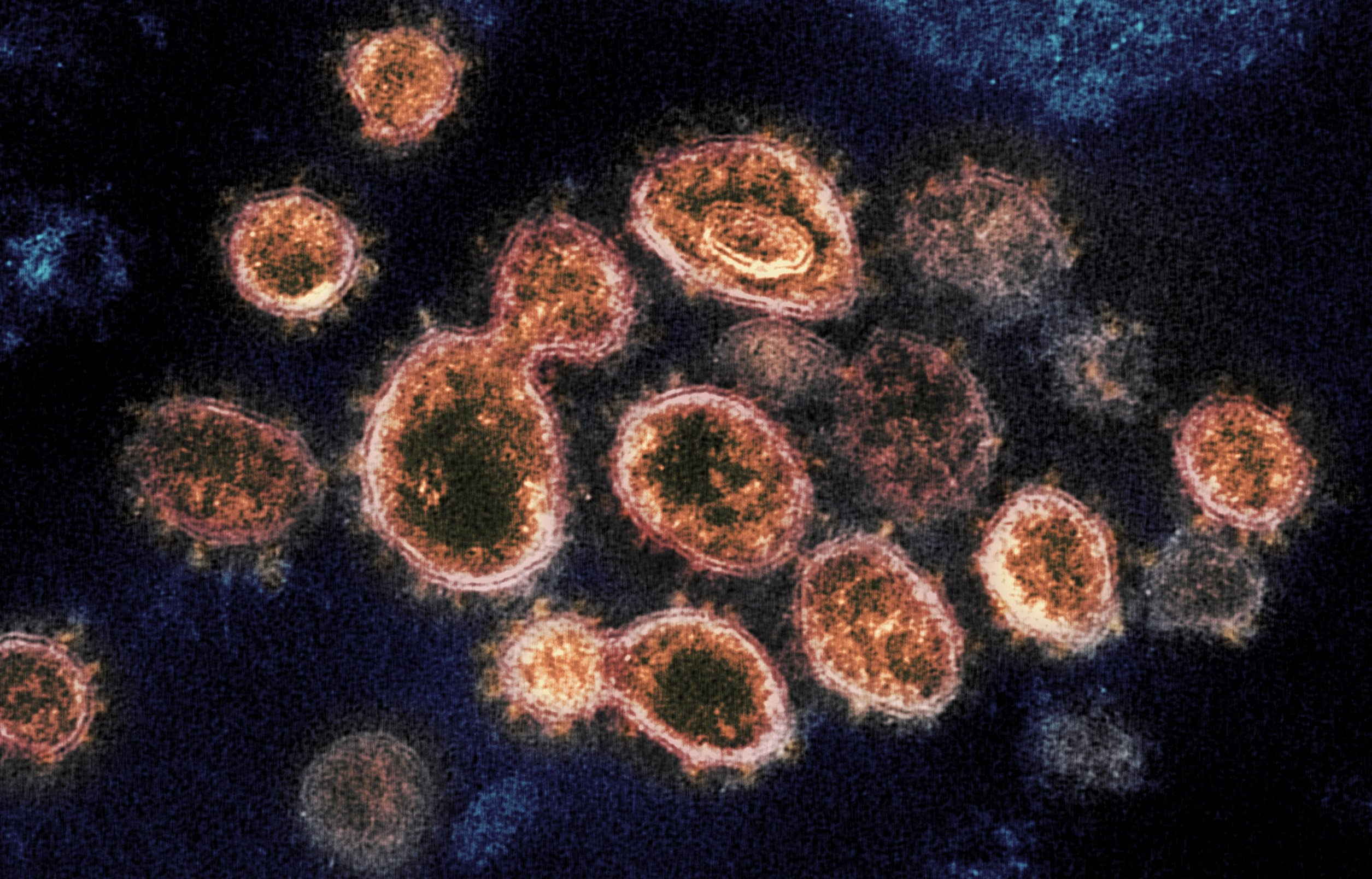 This 2020 electron microscope image provided by the National Institute of Allergy and Infectious Diseases - Rocky Mountain Laboratories shows SARS-CoV-2 virus particles isolated from a patient in the U.S., emerging from the surface of cells cultured in a lab. (NIAID-RML via AP)