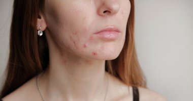 Stress can cause spikes in oil production, leading to acne lesions forming on the skin. (iStock Photo)