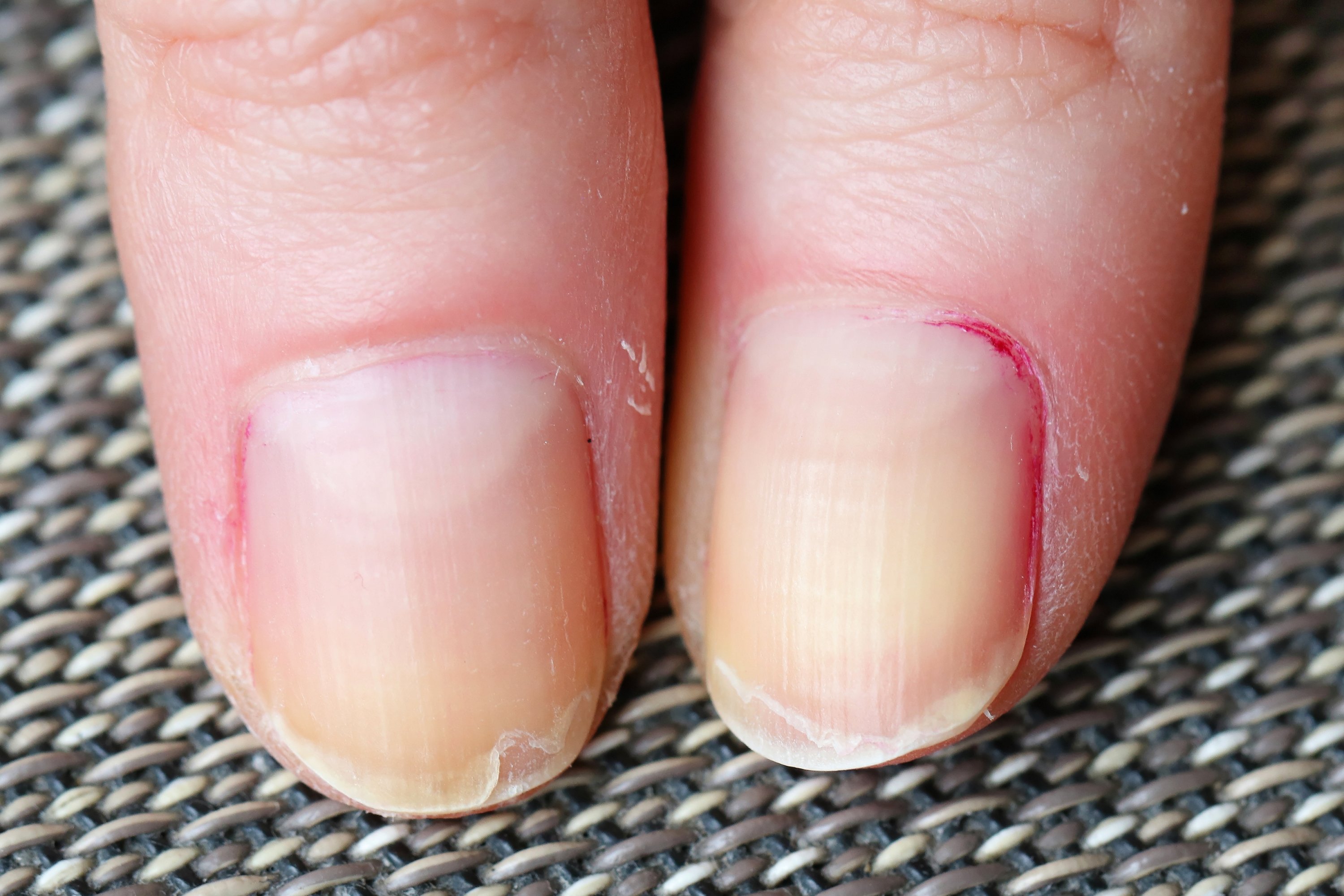 2. Nail Bed Color Changes in Anemia - wide 9