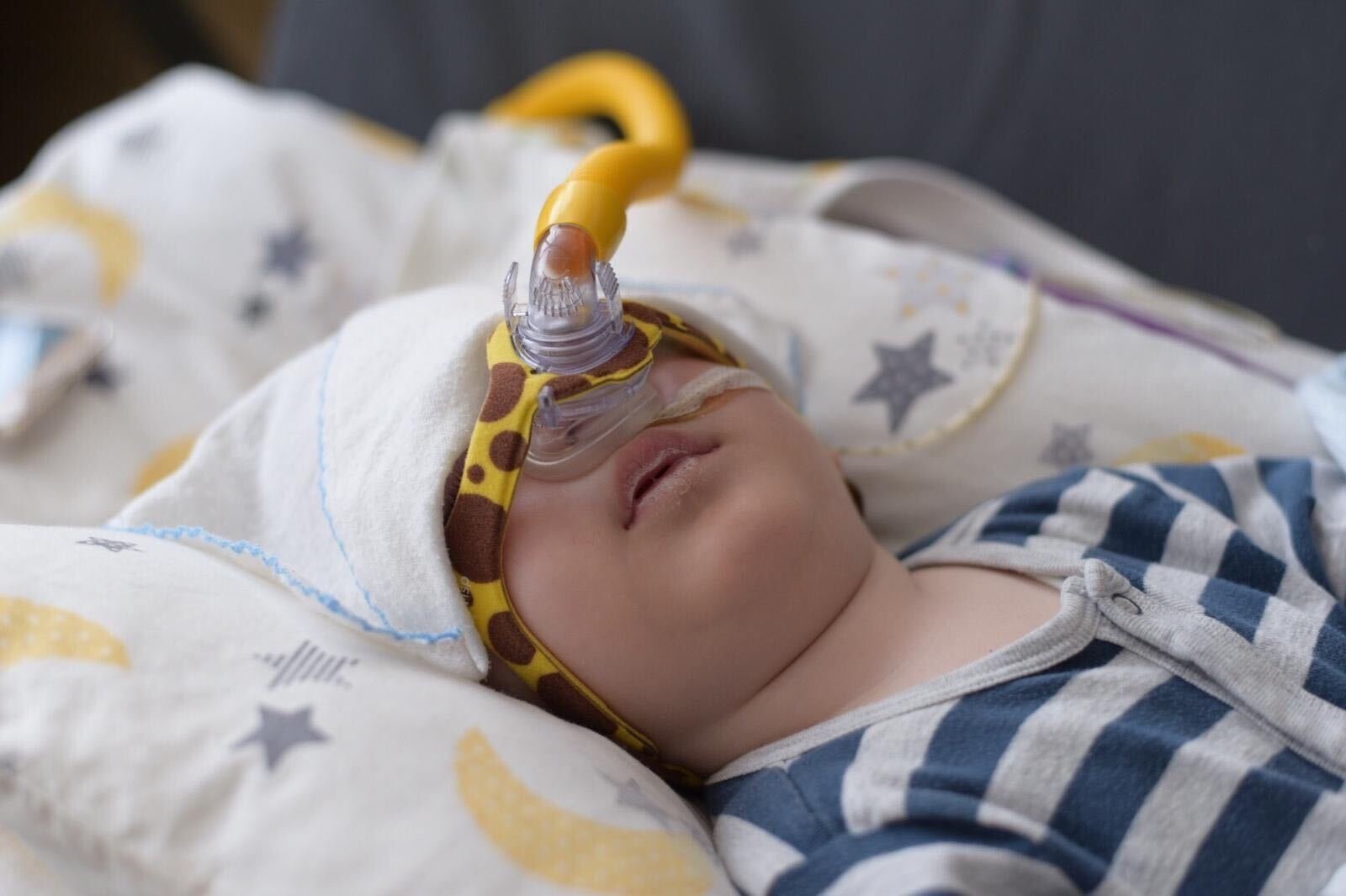 Eleven-month-old Metehan Fidan, unable to breathe properly due to SMA, depends on a machine to survive.