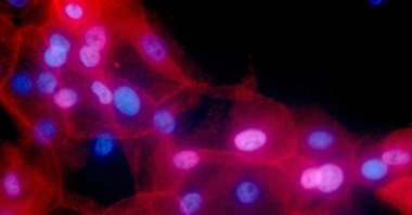 This undated fluorescence-colored microscope image made available by the National Institutes of Health in September 2016 shows a culture of human breast cancer cells. (National Cancer Institute via AP)