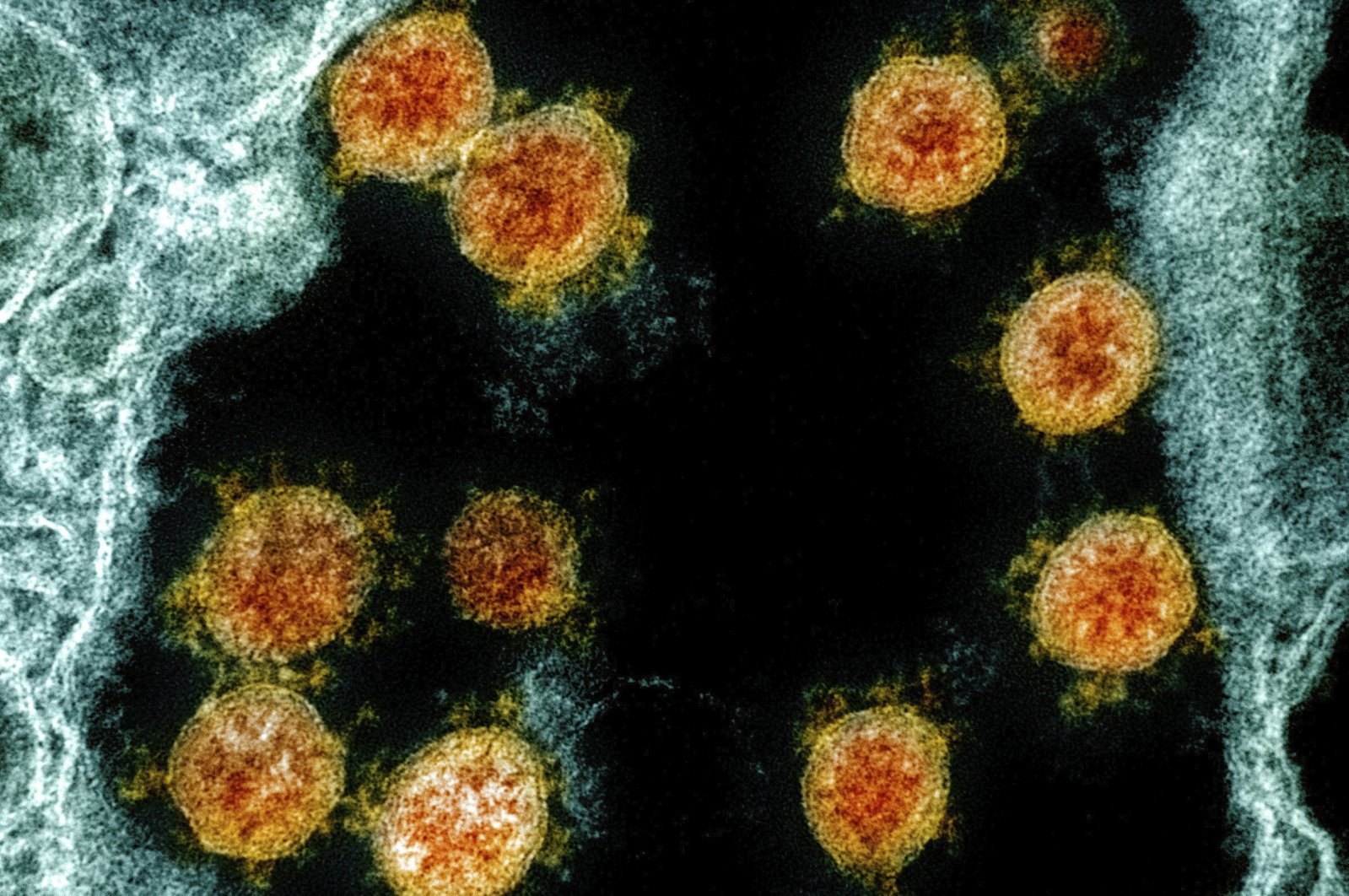 This electron microscope image made available and color-enhanced by the National Institute of Allergy and Infectious Diseases Integrated Research Facility in Fort Detrick, Md., in 2020, shows Novel Coronavirus SARS-CoV-2 virus particles, orange, isolated from a patient. (NIAID/National Institutes of Health via AP)