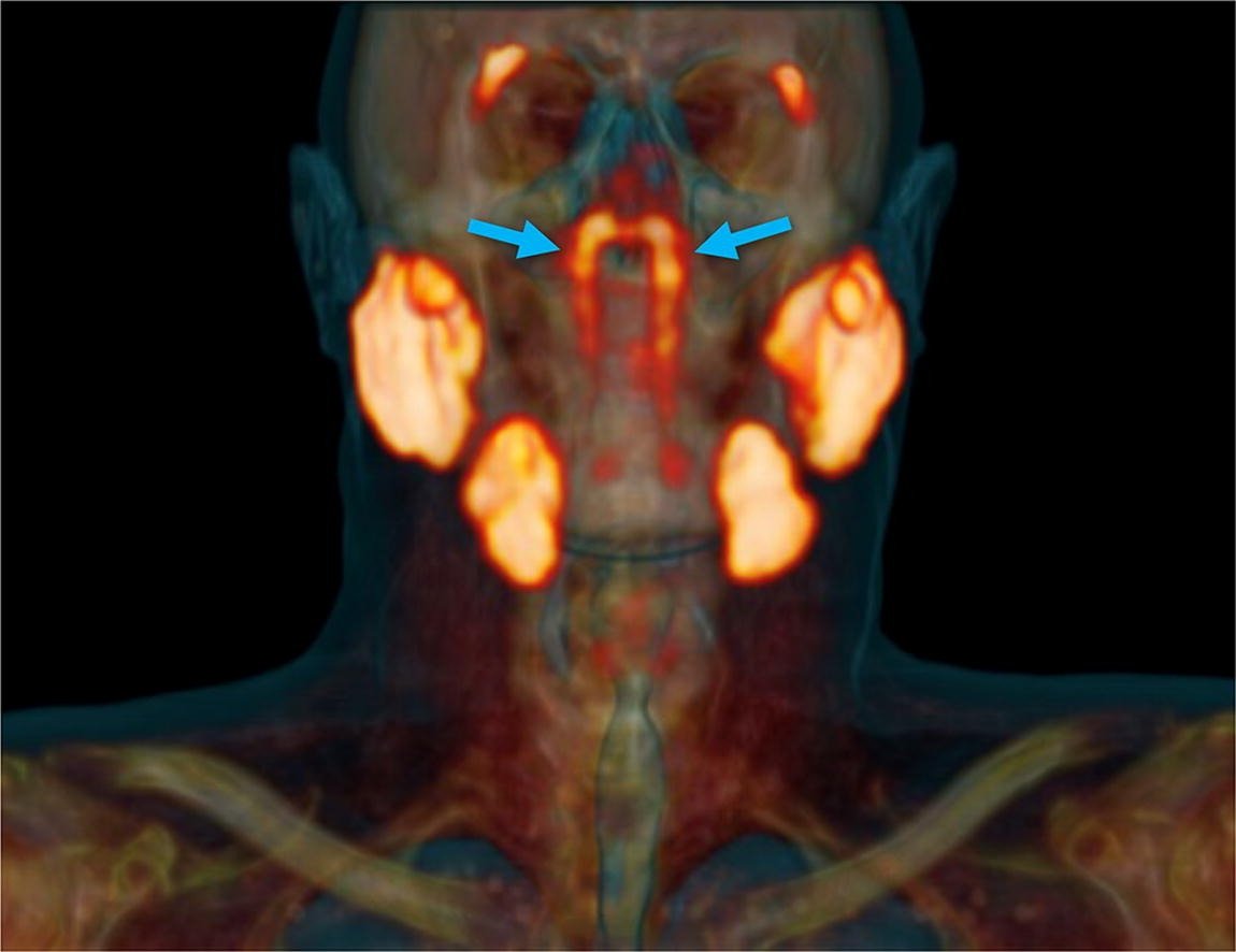 A three-dimensional representation of the PSMA PET/CT scan shows the location and extent of the tubarial glands in a random patient. (VALSTAR, ET. AL./RADIOTHERAPY AND ONCOLOGY)