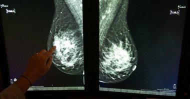 Dr. Georgia Giakoumis Spear points to dense breast tissue on a mammogram at Skokie Hospital on December 5, 2018. (via REUTERS)