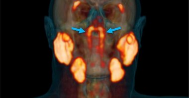 A three-dimensional representation of the PSMA PET/CT scan shows the location and extent of the tubarial glands in a random patient. (VALSTAR, ET. AL./RADIOTHERAPY AND ONCOLOGY)