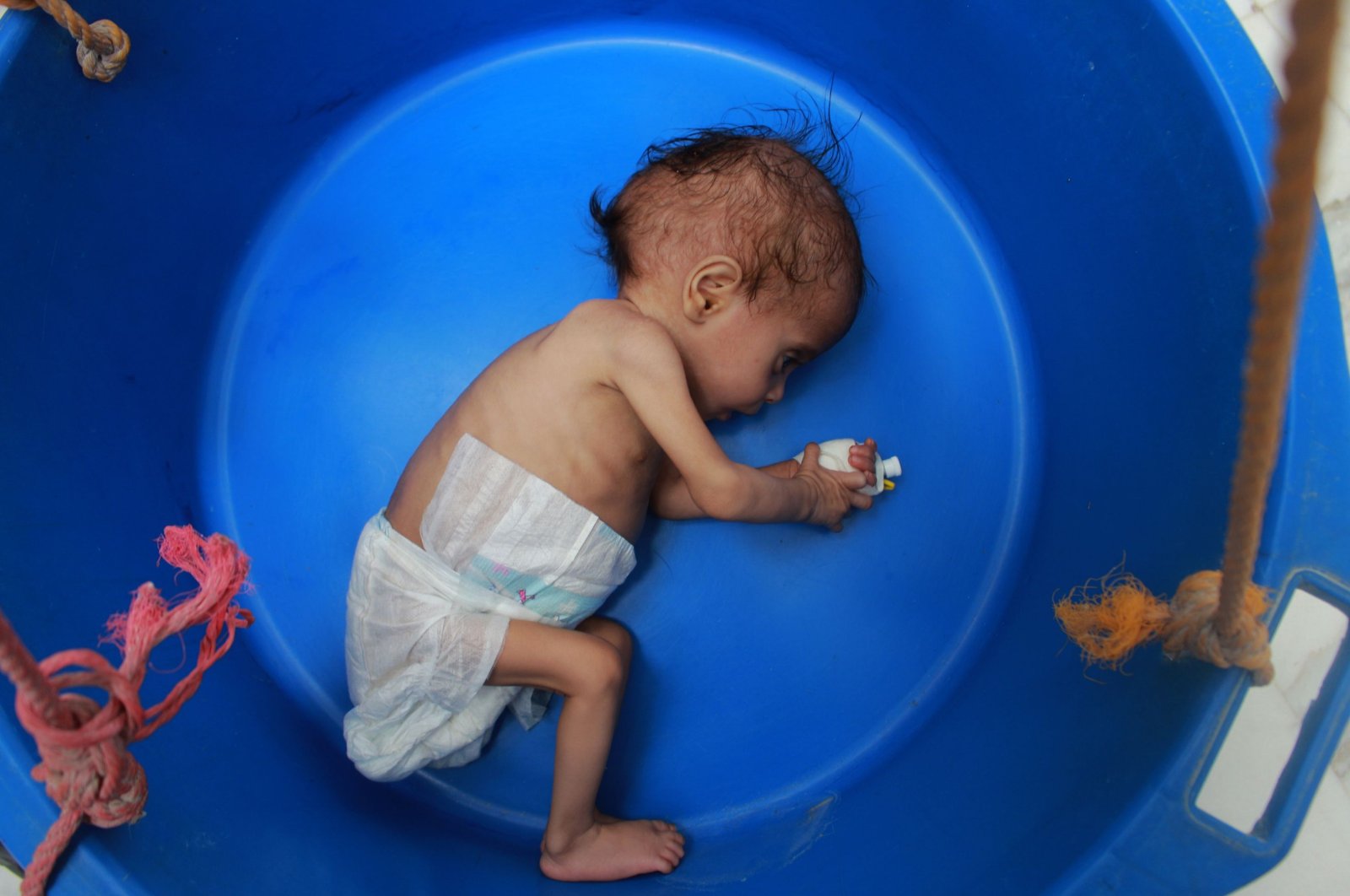 A Yemeni child suffering from malnutrition is weighed at a treatment center in Yemen's northern Hajjah province, July 5, 2020. (AFP Photo)