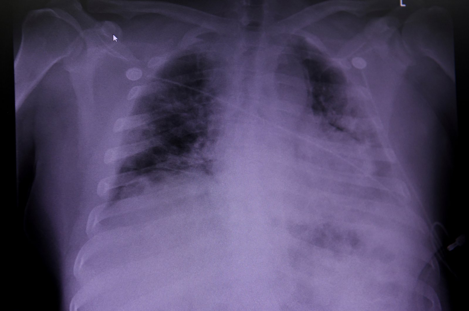An X-ray of a COVID-19 patient's lungs at United Memorial Medical Center in Houston, Texas, U.S., July 10, 2020. (Reuters Photo)