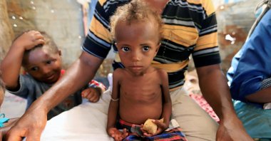 Hanaa Ahmad Ali Bahr, a malnourished girl sits on her father's lap in a shanty town in Hodeidah, Yemen, March 25, 2019. (Reuters Photo)