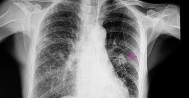 A chest X-ray shows a patient with pneumonia and a lung nodule. (Shutterstock Photo)