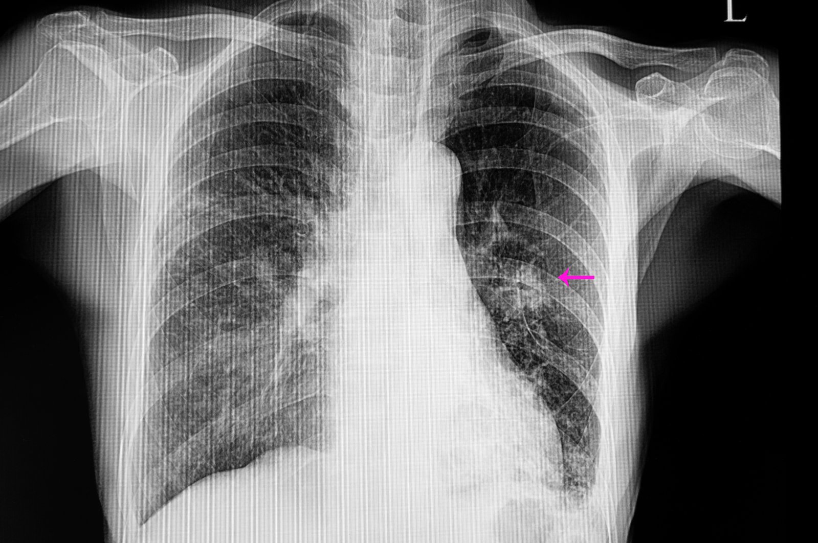 A chest X-ray shows a patient with pneumonia and a lung nodule. (Shutterstock Photo)