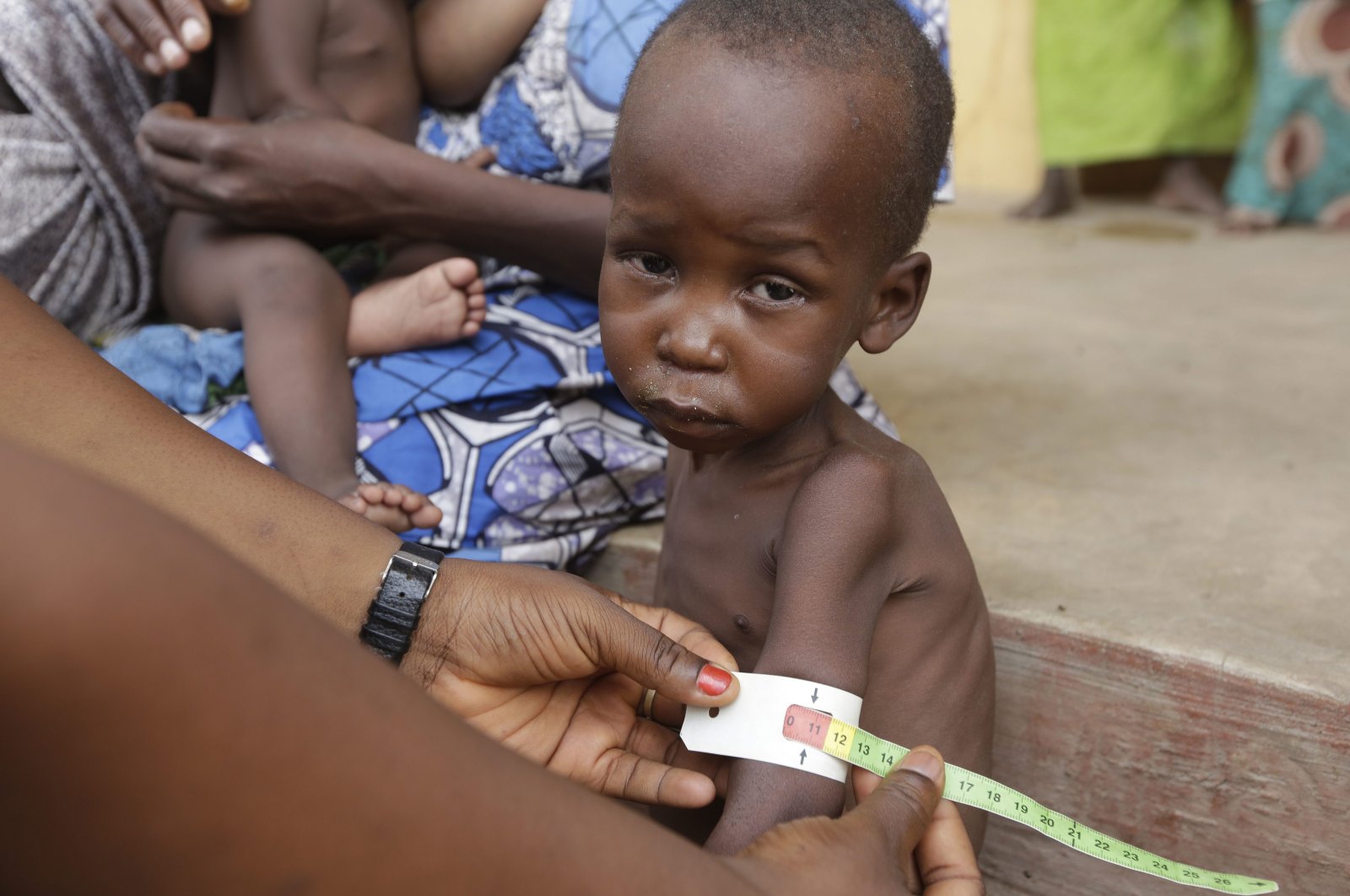 A doctor attends to a malnourished child at a refugee camp in Yola, Nigeria on  May 3, 2015. (AP Photo)