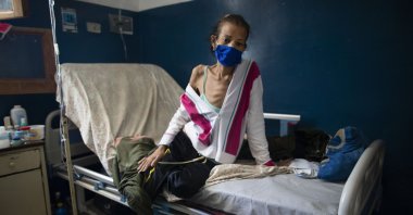 A woman who suffers from cervical cancer sits in her room at the Luis Razetti Oncology Hospital in Caracas, Venezuela, on Sept. 2, 2020. (AP Photo)