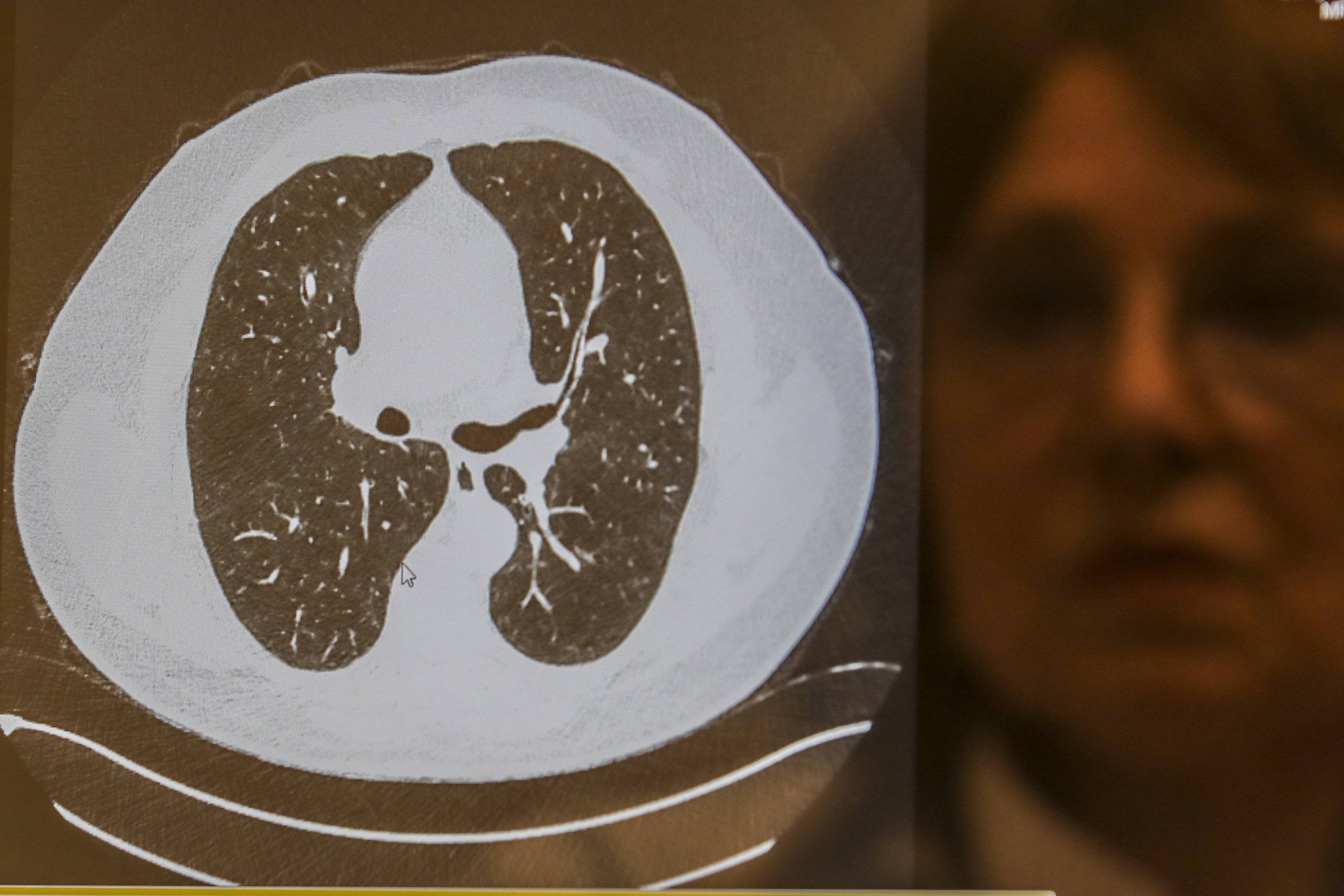 Prof. Dr. Iftahar Köksal shows an image of the lungs of a patient, infected with COVID-19 at Acıbadem Hospital in Istanbul, Dec. 21, 2020. (AP Photo)