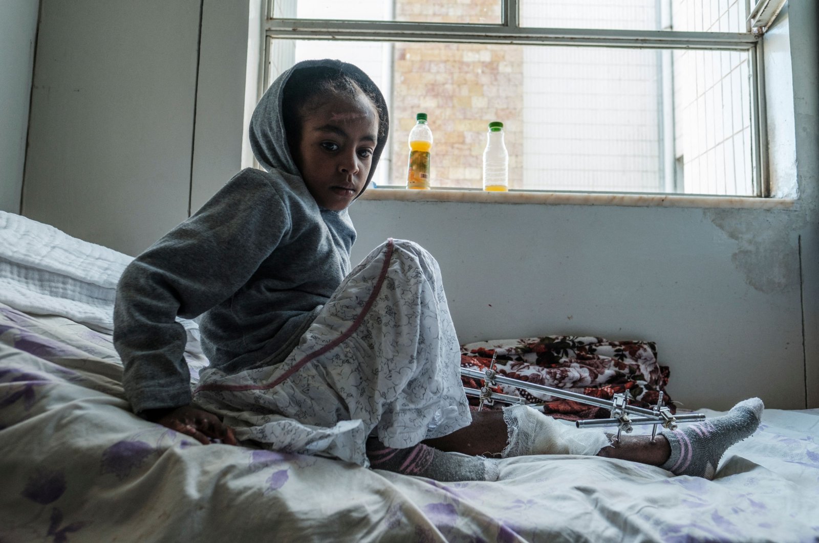Arsema Berha, 9-years-old, rests on her bed at the Ayder Referral Hospital in the Tigray capital Mekele on Feb. 25, 2021. (AFP Photo)