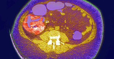 A radial CT scan shows colon cancer, a tumor on the caecum and an ileocolic valve. (BSIP/Universal Images Group via Getty Images)