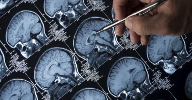 A doctor analyzes the magnetic resonance image (MRI) brain scan of the head and skull of a person. (Getty Images)