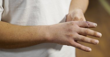 Berk Altınelli shows his severed finger a surgeon reattached, in Istanbul, Turkey, April 11, 2021. (DHA PHOTO)