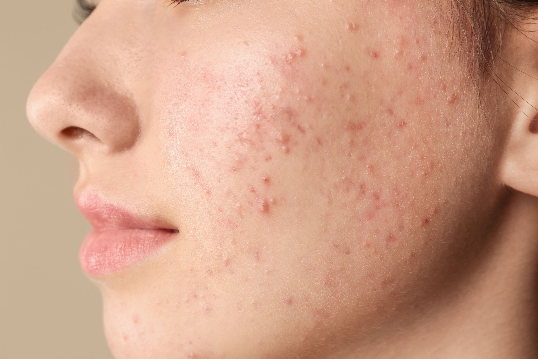 Acne-Cause-Diagnosis-best treatment-Homeopathic treatment-best dermatologist in Pakistan-Dr Qaisar Ahmed