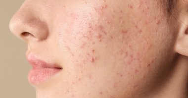 One expert believes persistent adult acne could be indirectly caused by climate change. (Shutterstock Photo)