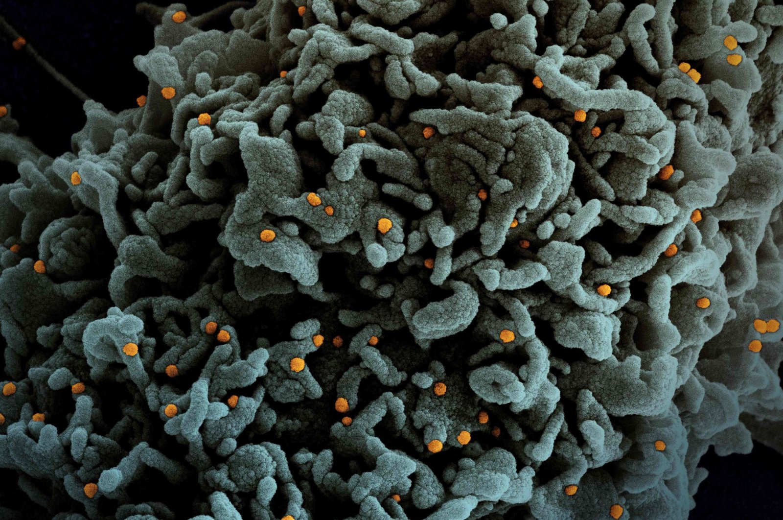 This photo provided by National Institute of Allergy and Infectious Disease (NIAID) shows a colorized scanning electron micrograph of a cell (teal) infected with U.K.'s B.1.1.7 variant of COVID-19 virus particles (orange), isolated from a patient sample, March 31, 2021. (NIAID via AFP)