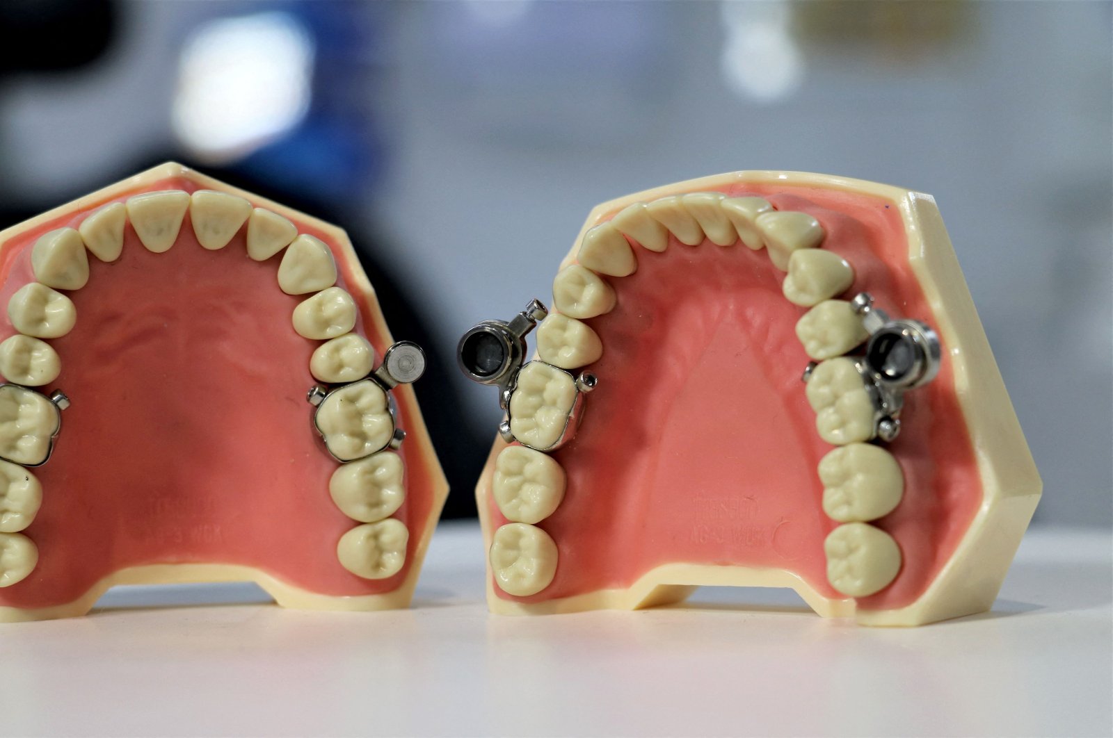 A weight-loss device created by New Zealand researchers that use magnets to clamp a patient's jaw together which critics liken to an instrument of medieval torture, Dunedin, New Zealand, June 29, 2020. (University of Otago via AFP)