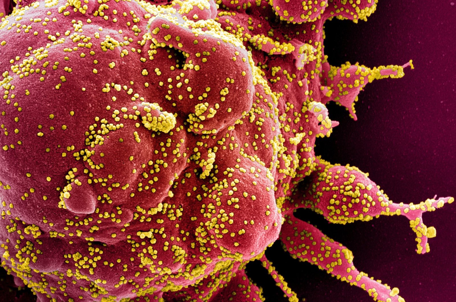 A colorized scanning electron micrograph of an apoptotic cell (red) infected with COVID-19 virus particles (yellow) isolated from a patient sample. (NIAID via Reuters)
