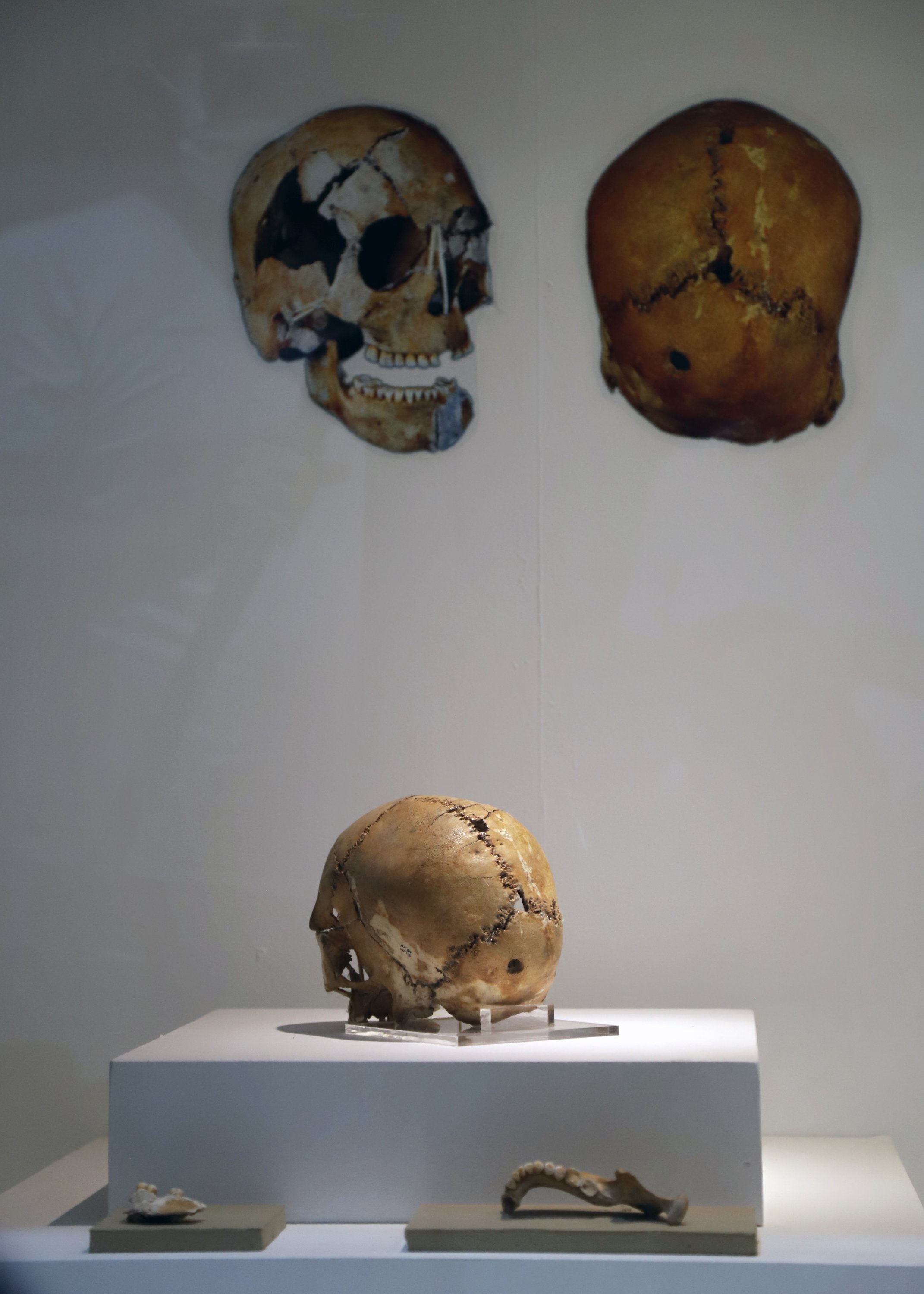 The skull featuring the traces of brain surgery on display at Aksaray Museum, central Turkey, August 25, 2021. (AA Photo) 