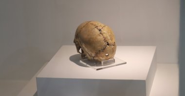 The skull featuring the traces of brain surgery on display at Aksaray Museum, central Turkey, August 25, 2021. (AA Photo)