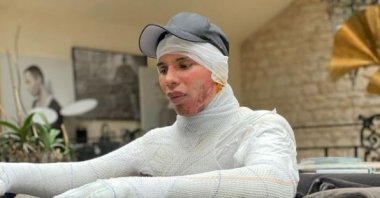 Designer Olivier Rousteing shared a photo on Instagram on Oct. 9, 2021, showing injuries he suffered from a fireplace explosion last year. (Instagram/Olivier Rousteing)