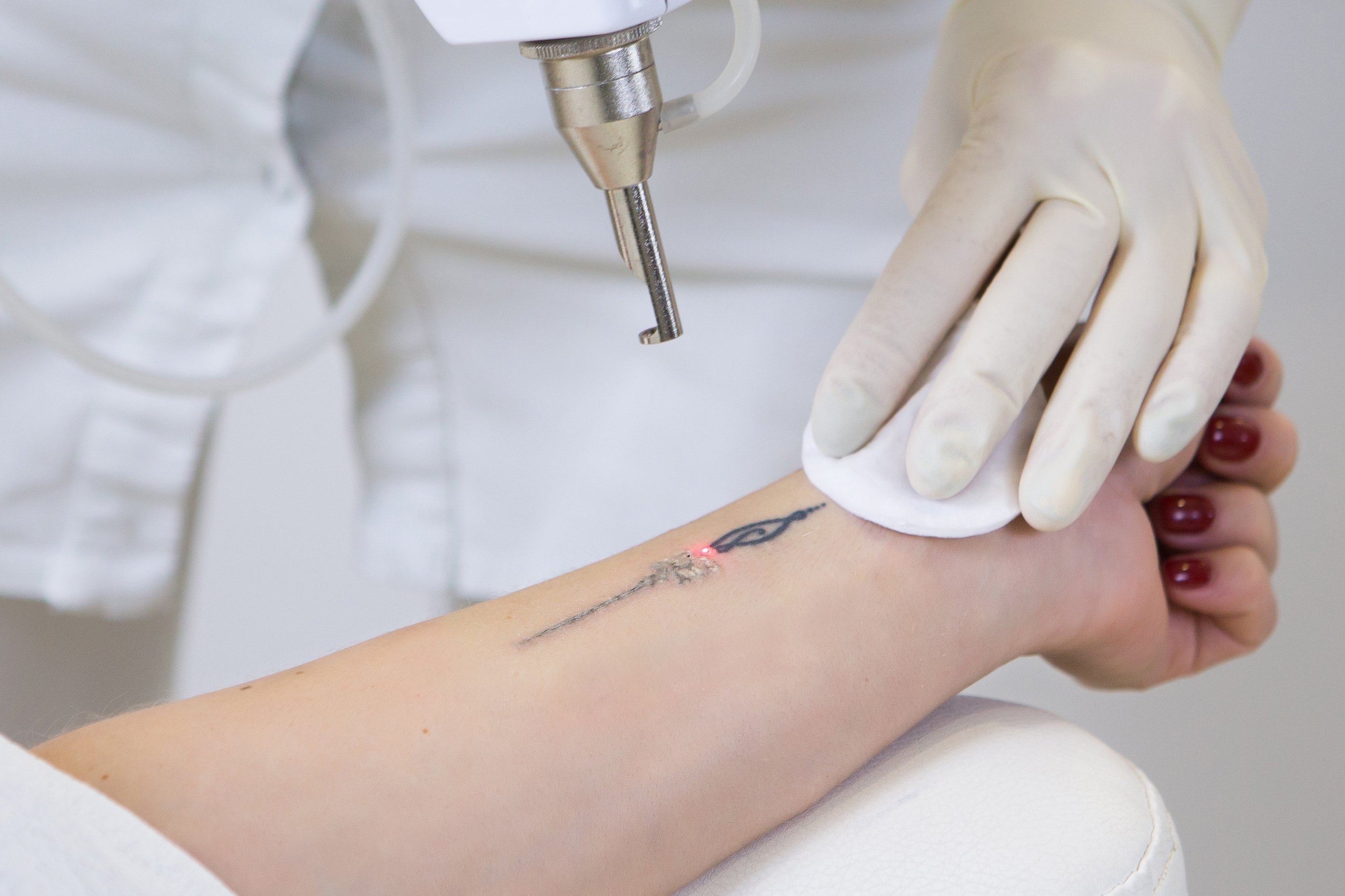 No way back? Tattoo removal is painful but possible | Daily Sabah