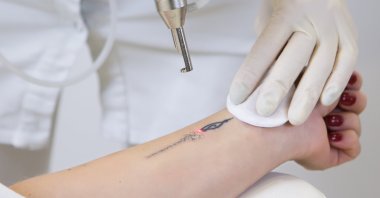 If a tattoo is removed by laser, the treatment usually has to be repeated several times. (Shutterstock Photo) 