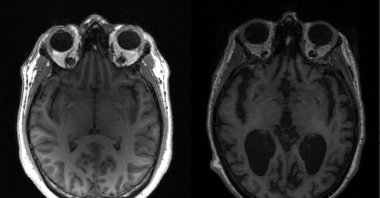 This undated image courtesy of, Dr. Timothy Rittman, University of Cambridge, shows an MRI image of a healthy brain (L) and an Alzheimer's brain (R) with large black gaps where brain has shrunk. (Photo by Timothy Rittman / University of Cambridge / AFP) 