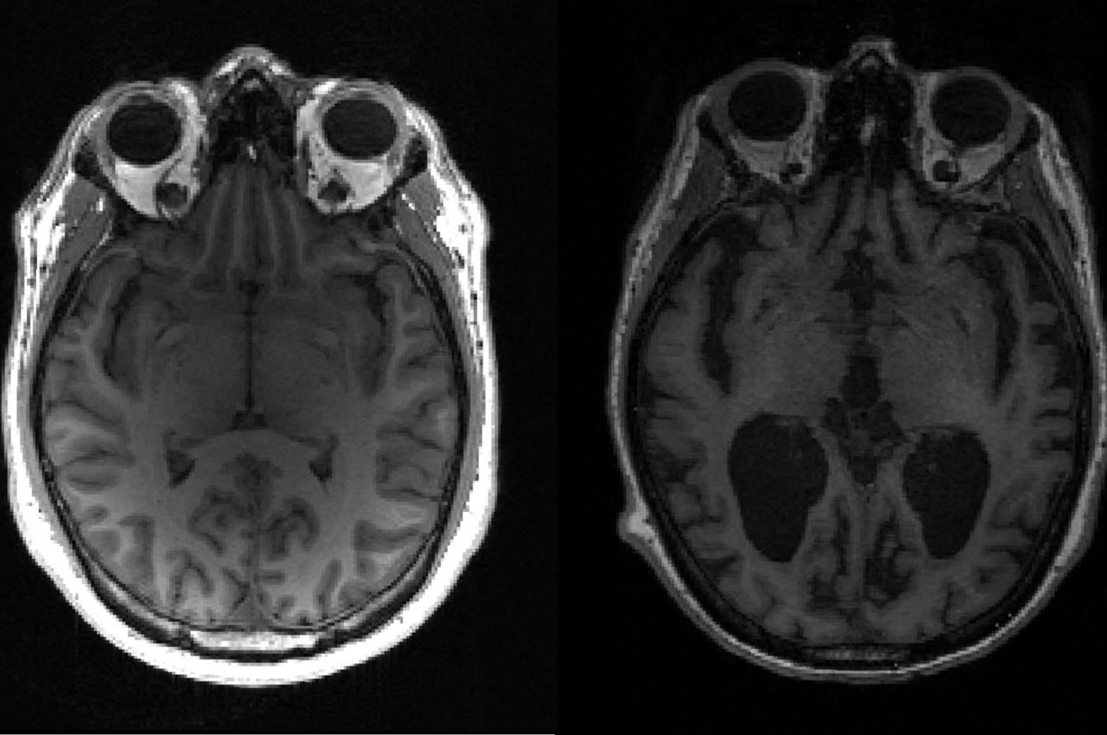 This undated image courtesy of, Dr. Timothy Rittman, University of Cambridge, shows an MRI image of a healthy brain (L) and an Alzheimer's brain (R) with large black gaps where brain has shrunk. (Photo by Timothy Rittman / University of Cambridge / AFP) 