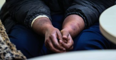 Somalian national Muna Hasım Dra, a migrant pushed back and beaten by Greek forces, is seen at the regional migration directorate in Izmir, Turkey, Nov. 20, 2021 (AA Photo)