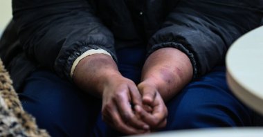 Somalian national Muna Hasım Dra, a migrant pushed back and beaten by Greek forces, is seen at the regional migration directorate in Izmir, Turkey, Nov. 20, 2021. (AA Photo)